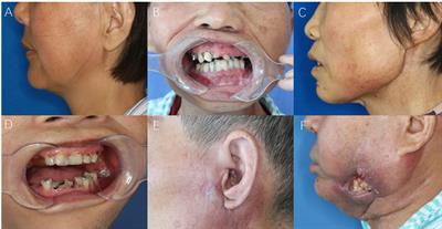 Radiation-Induced Soft Tissue Injuries in Patients With Advanced Mandibular Osteoradionecrosis: A Preliminary Evaluation and Management of Various Soft Tissue Problems Around Radiation-Induced Osteonecrosis Lesions